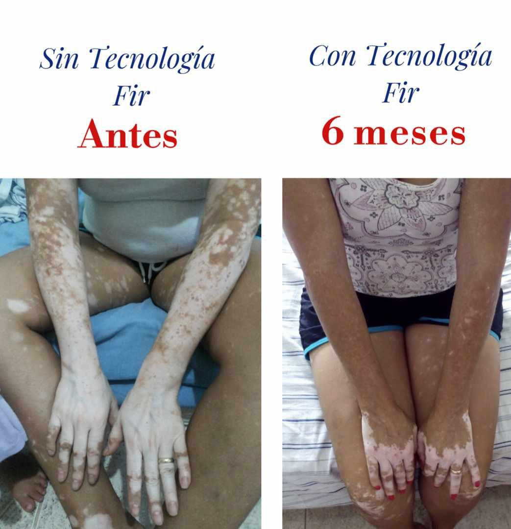 Vitiligo Nipponflex Vitiligo Nipponflex