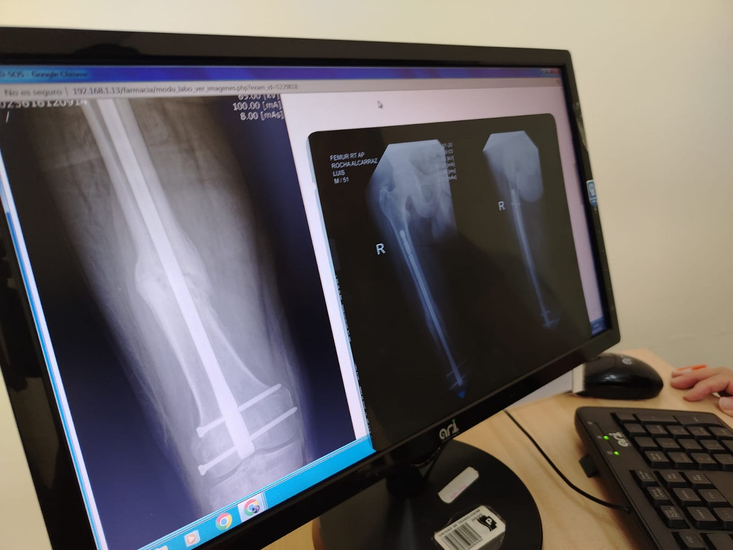 Experiencia real Femur